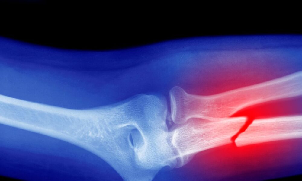 Microplastics Could Be Weakening Your Bones, Research Suggests