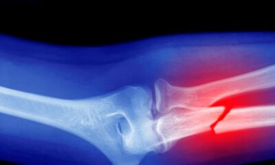 Microplastics Could Be Weakening Your Bones, Research Suggests