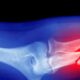 Microplastics Could Be Weakening Your Bones, Research Suggests