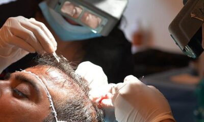 Dubai police arrest man running illegal hair transplant clinic