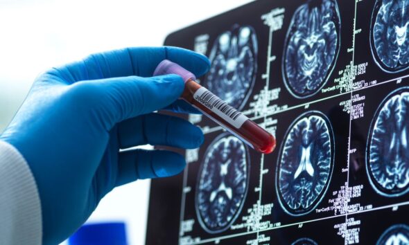Blood Tests for Alzheimer’s Are Here