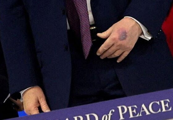 Trump’s hands seen bruised in new photos