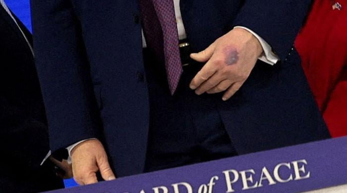 Trump’s hands seen bruised in new photos