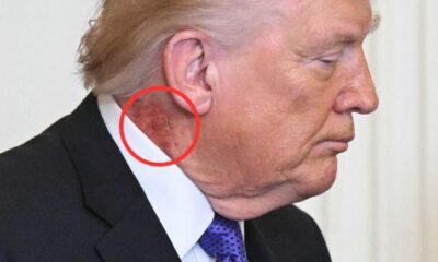 Trump’s neck rash sparks fresh health questions