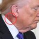 Trump’s neck rash sparks fresh health questions