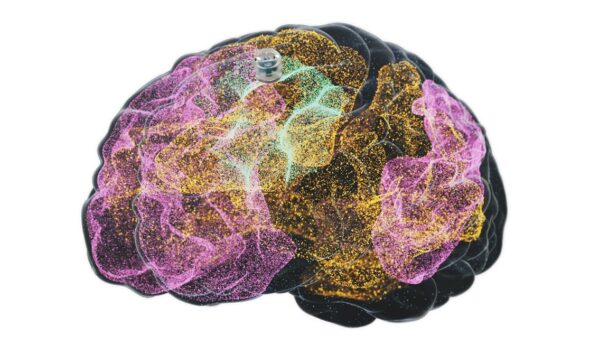 A Brain Implant for Depression Is About to Be Tested in Humans