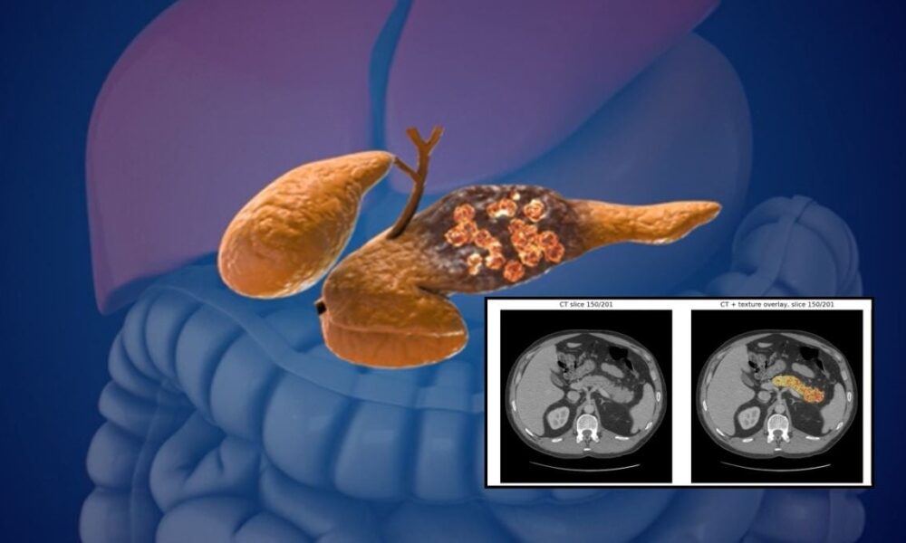 AI detects pancreatic cancer 3 years before diagnosis: Study reveals breakthrough results
