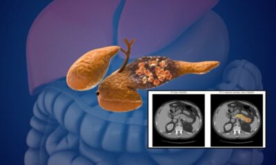 AI detects pancreatic cancer 3 years before diagnosis: Study reveals breakthrough results