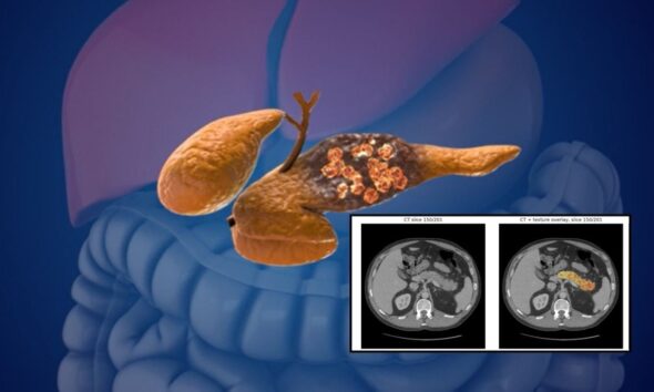 AI detects pancreatic cancer 3 years before diagnosis: Study reveals breakthrough results
