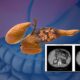 AI detects pancreatic cancer 3 years before diagnosis: Study reveals breakthrough results