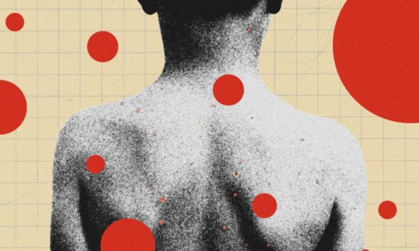 The Backward Logic of Chickenpox Parties